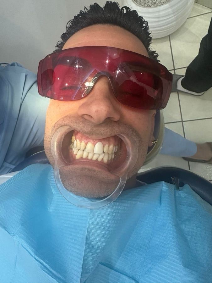 Antes tratamiento carillas dentales Marrakech
